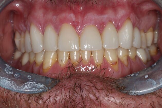 Veneers: Case 26 - After Veneers