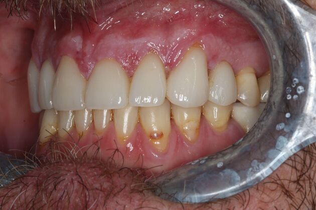 Veneers: Case 26 - Before