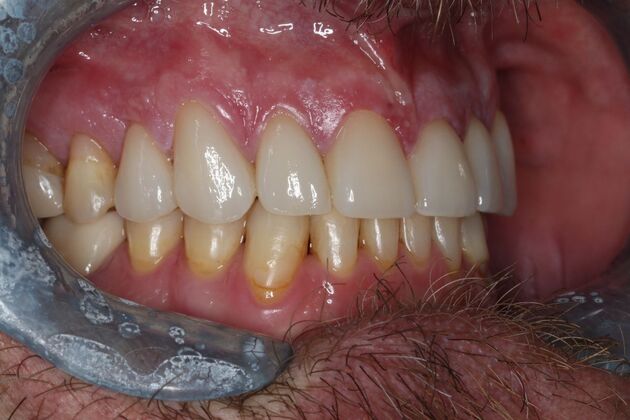 Veneers: Case 26 - After