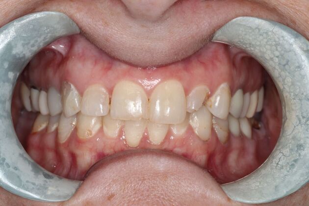 Veneers: Case 27 - Before