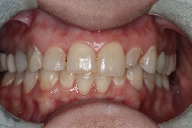 Veneers: Case 27 - Before