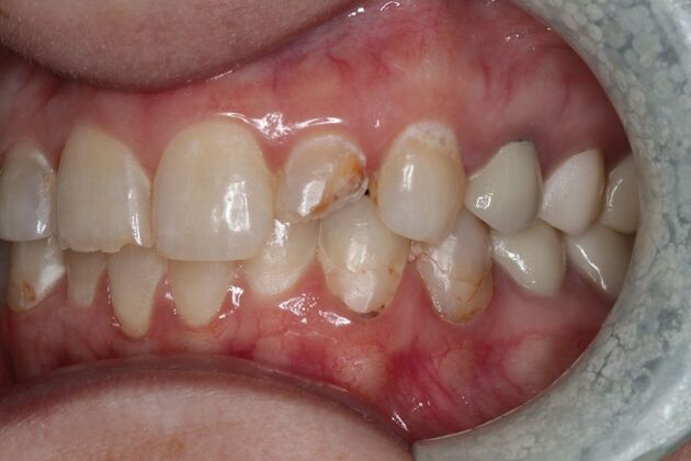 Veneers: Case 27 - Before