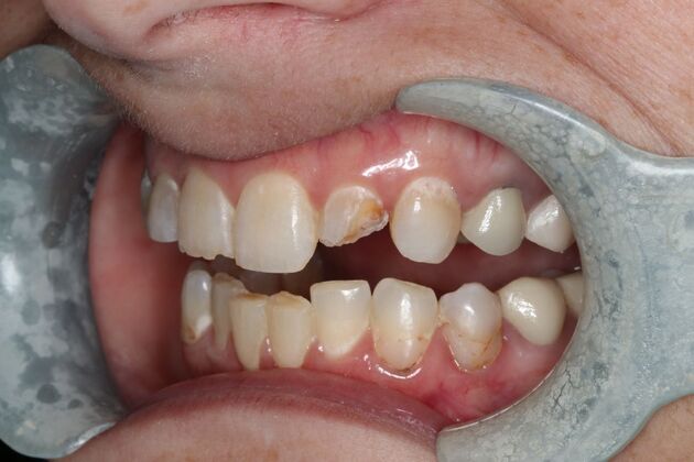 Veneers: Case 27 - Before