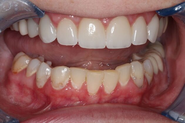 Veneers: Case 27 - Before