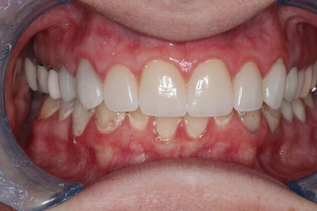 Veneers: Case 27 - After Top Veneers