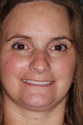 Veneers: Case 27 - Before