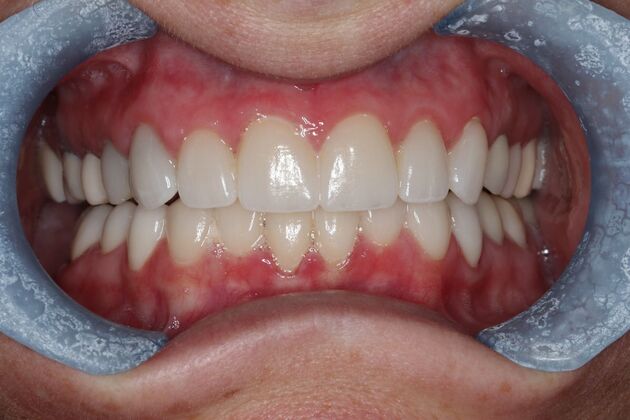 Veneers: Case 27 - After