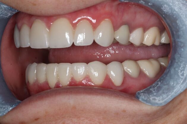 Veneers: Case 27 - After Top and Bottom Veneers