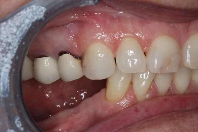 Dentures: Case 15 - Before