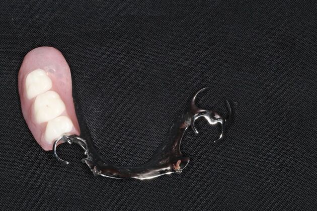 Dentures: Case 15 - Upper Partial Denture