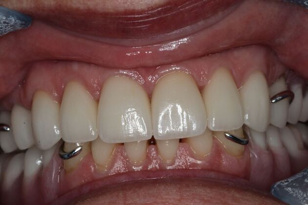 Dentures: Case 15 - After Upper/ Lower Partial Denture