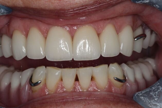 Dentures Case 15 - After