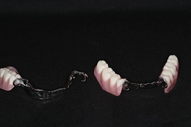 Dental Crowns: Case 33 - Top and Bottom Partial Denture