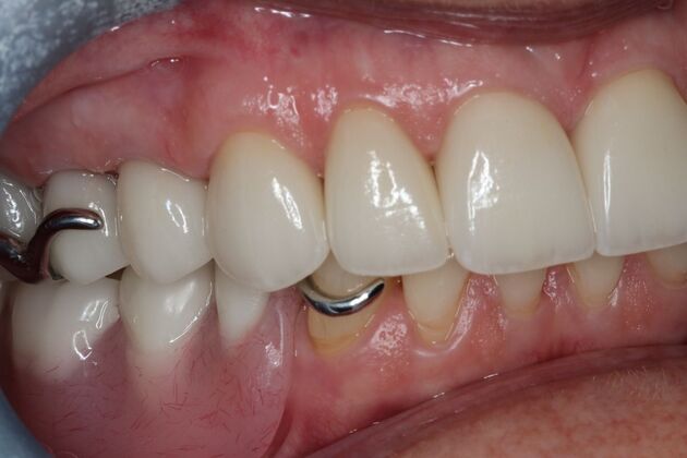 Dental Crowns: Case 33 - After