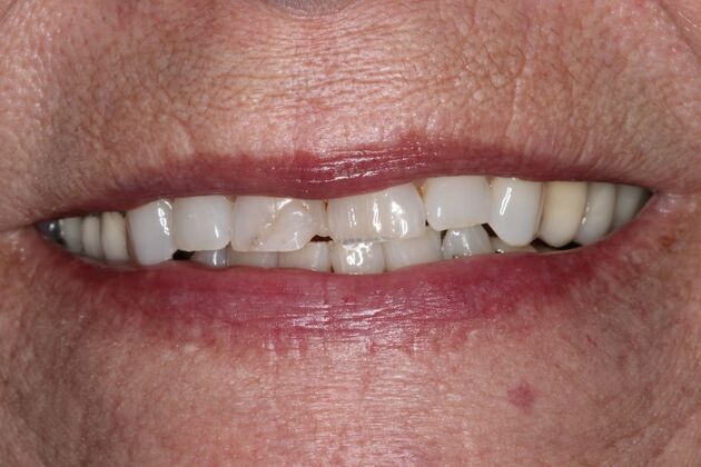 Dental Crowns Case 33 - Before