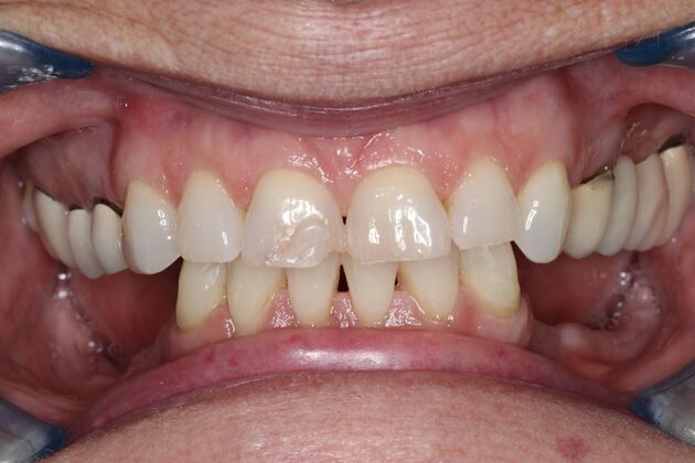 Dental Crowns: Case 33 - Before