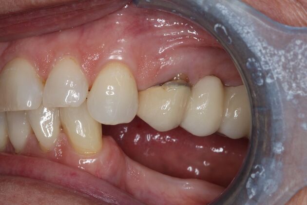 Dental Crowns: Case 33 - Before