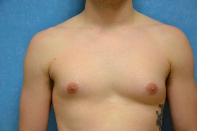 Gynecomastia Case 1507- Continental, OH - Before