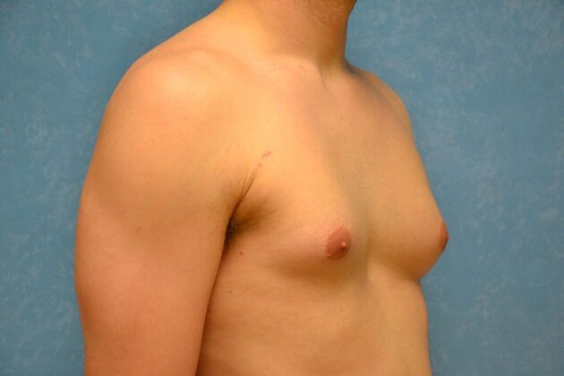 Gynecomastia: Case 1507- Continental, OH - Before