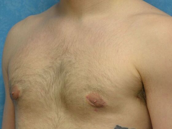 Gynecomastia: Case 1507- Continental, OH - After