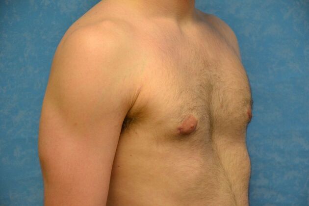 Gynecomastia: Case 1507- Continental, OH - After