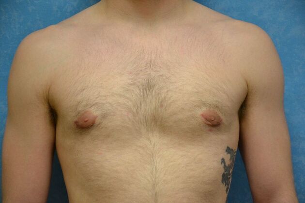 Gynecomastia Case 1507- Continental, OH - After