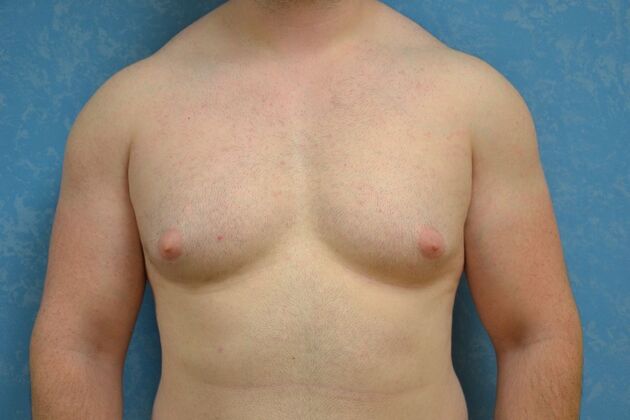 Gynecomastia Case 1508- Toledo, OH - Before
