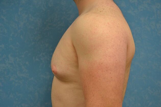 Gynecomastia: Case 1508- Toledo, OH - Before