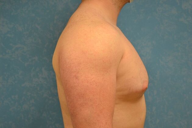 Gynecomastia: Case 1508- Toledo, OH - Before