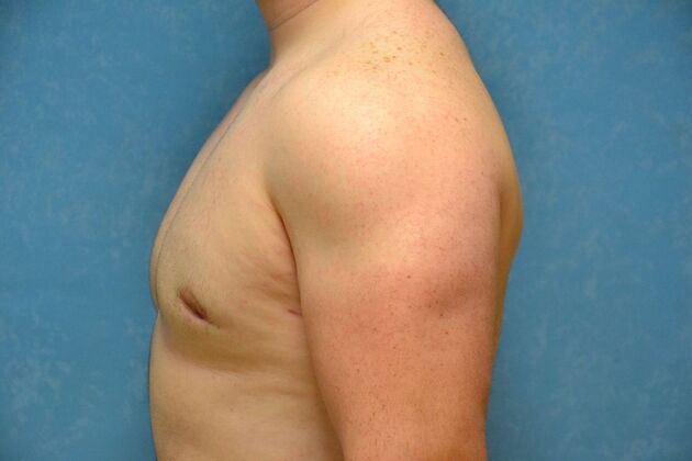 Gynecomastia: Case 1508- Toledo, OH - After