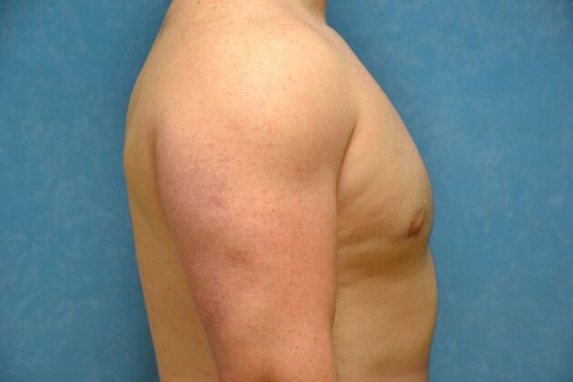 Gynecomastia: Case 1508- Toledo, OH - After