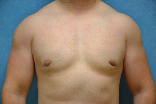 Gynecomastia Case 1508- Toledo, OH - After
