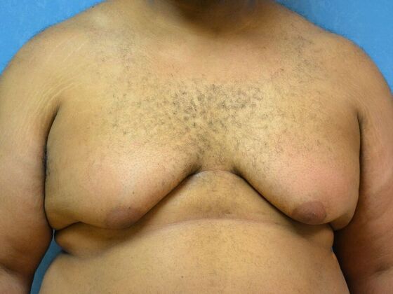 Gynecomastia Case 1509- Toledo, OH - Before