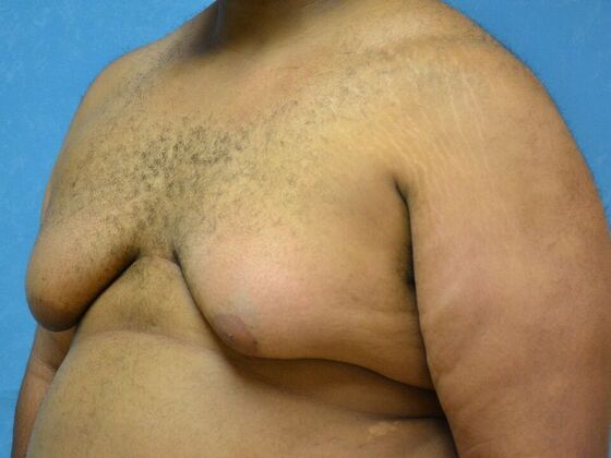 Gynecomastia: Case 1509- Toledo, OH - Before