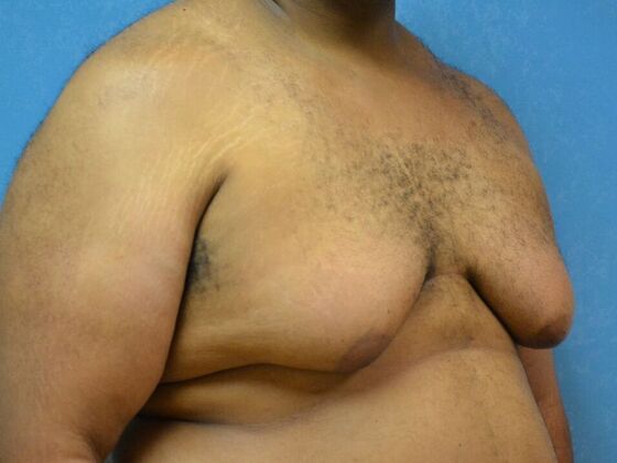 Gynecomastia: Case 1509- Toledo, OH - Before