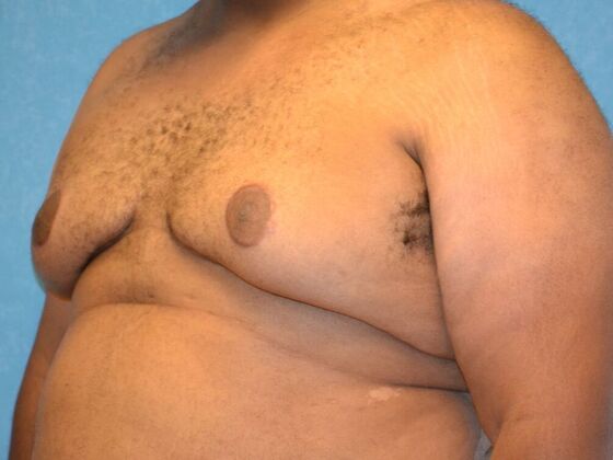 Gynecomastia: Case 1509- Toledo, OH - After