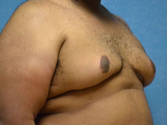 Gynecomastia: Case 1509- Toledo, OH - After
