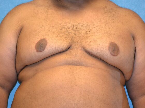 Gynecomastia Case 1509- Toledo, OH - After