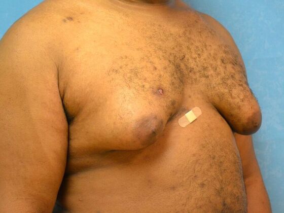 Gynecomastia: Case 1510- Warren, MI - Before