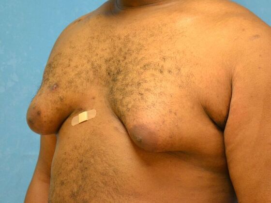 Gynecomastia: Case 1510- Warren, MI - Before