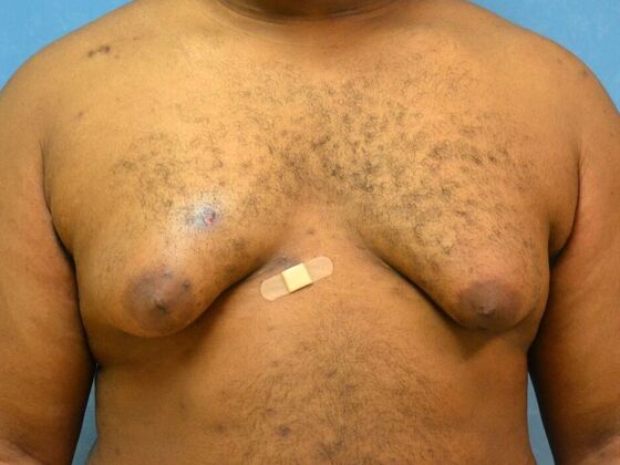 Gynecomastia Case 1510- Warren, MI - Before