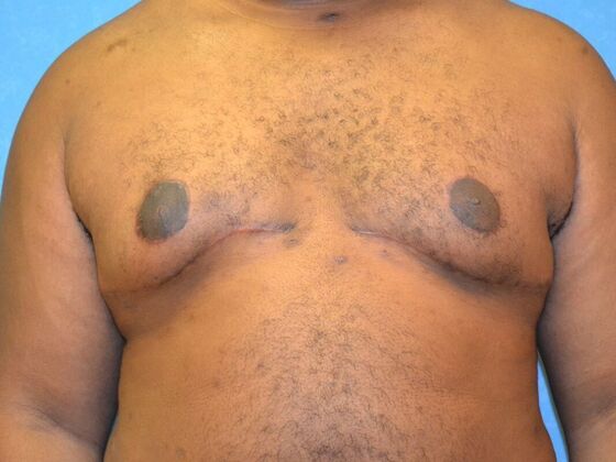 Gynecomastia Case 1510- Warren, MI - After