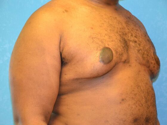 Gynecomastia: Case 1510- Warren, MI - After