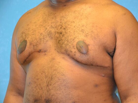 Gynecomastia: Case 1510- Warren, MI - After