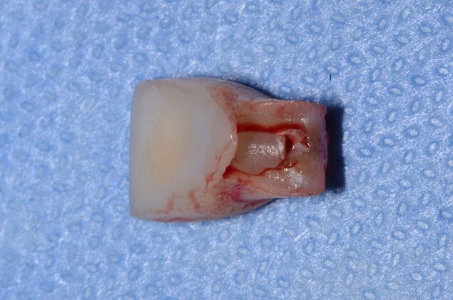 Dental Implants Case 56 - After