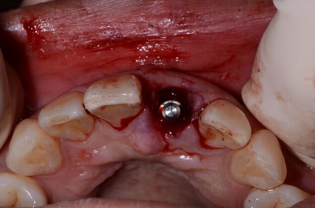 Dental Implants: Case 56 - implant placed at time of extraction