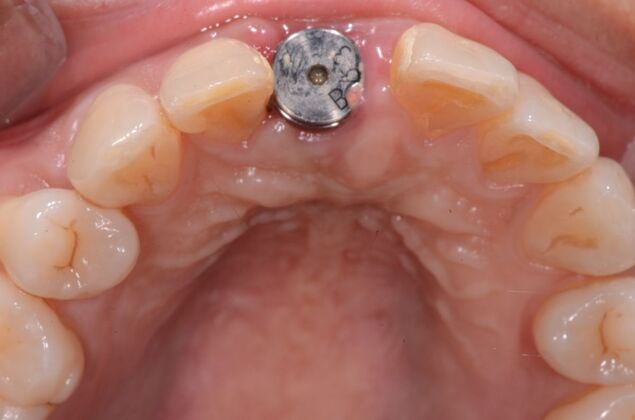 Dental Implants: Case 56 - Implant healing with healing collar