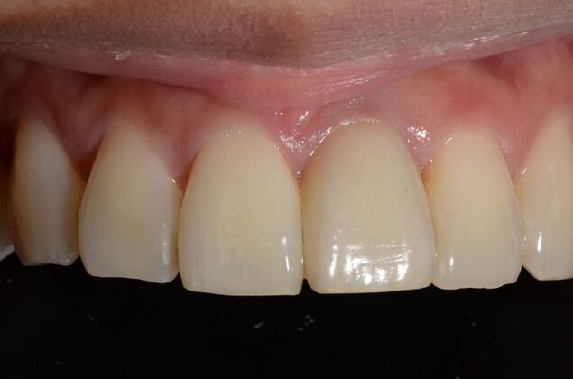 Dental Implants: Case 56 - Final implant crown placed