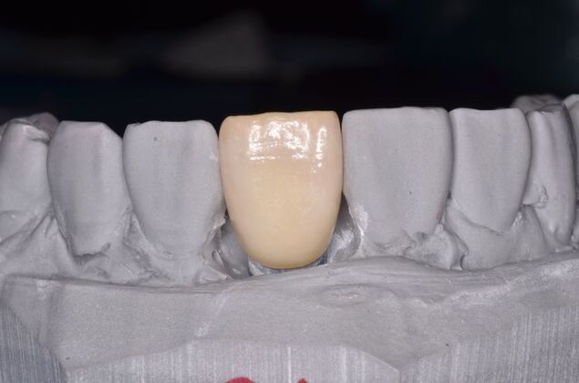 Dental Implants: Case 56 - Screw retained crown on model