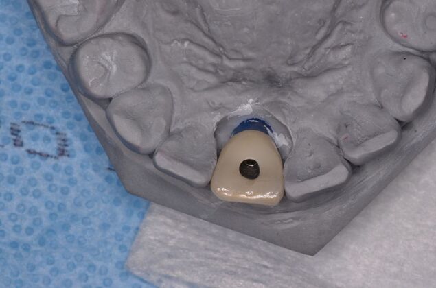 Dental Implants: Case 56 - Screw retained crown on model